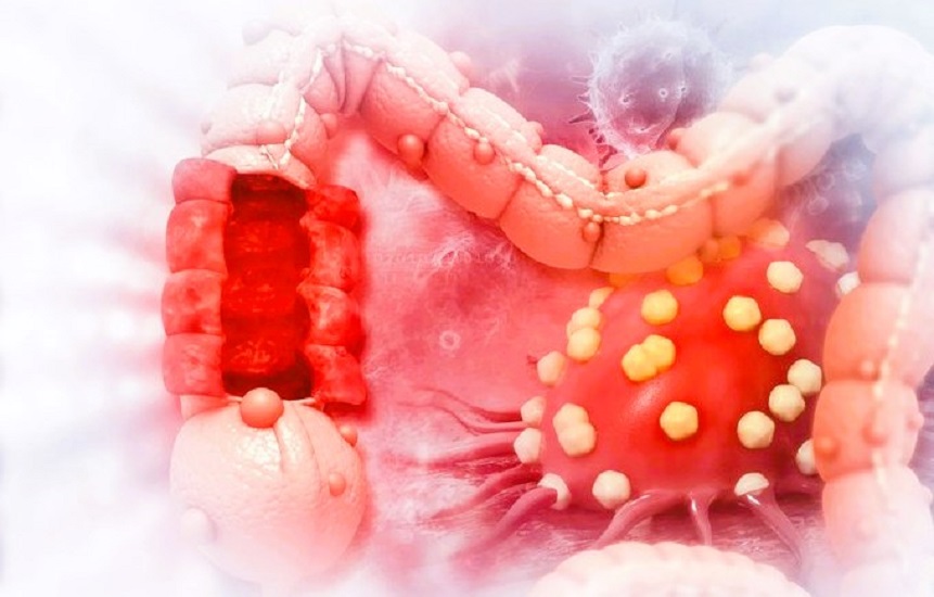 Breaking Discovery: New Molecule Heals Intestines and Stops Cancer Growth with Liver X Receptor (LXR) Power